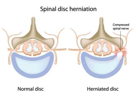 normal-and-herniated-disc