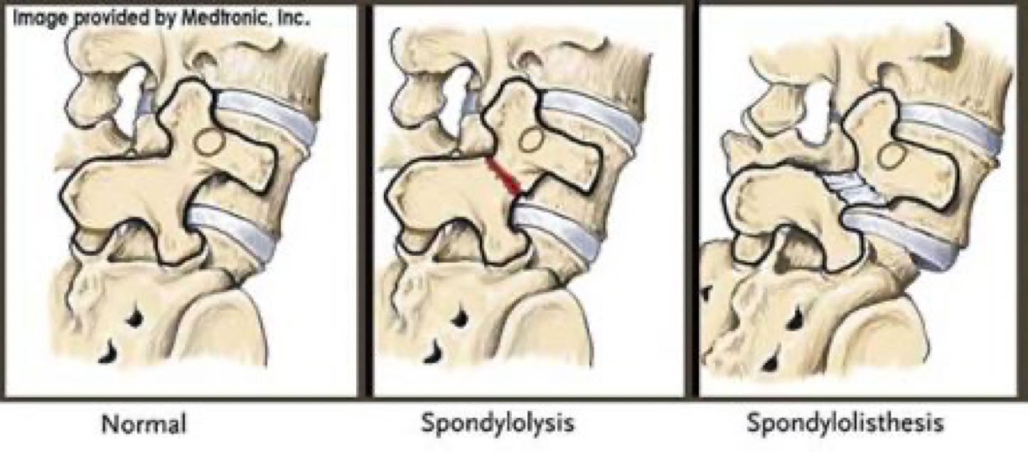 spondylolysis and spondylolisthesis