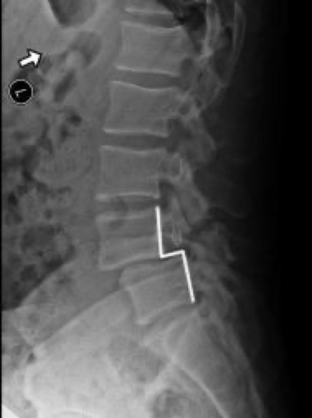 anterior slippage of vertebra