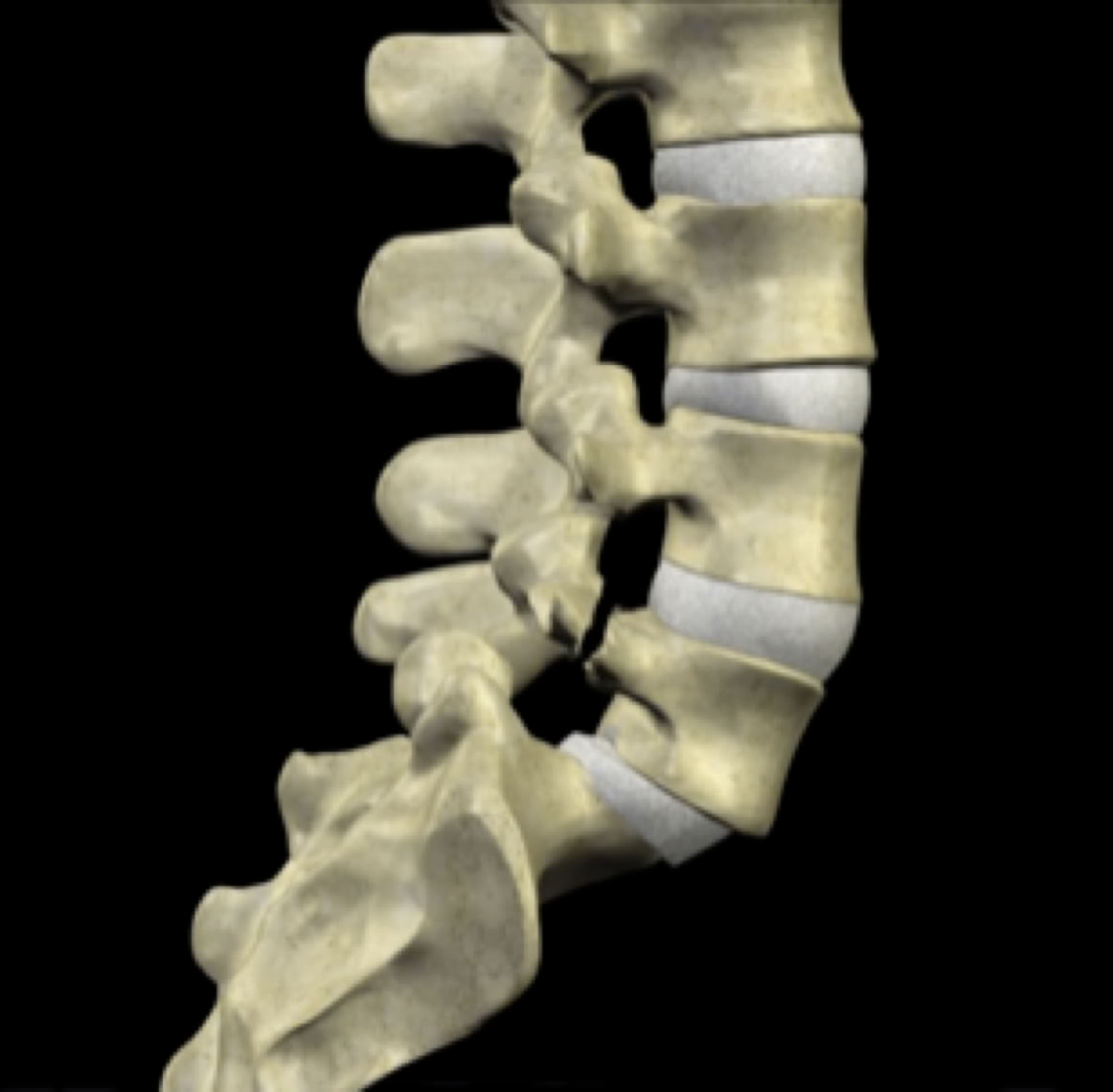 spondylolisthesis with pars defect